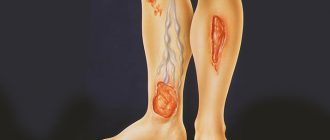 Чем лечить варикозные язвы на ногах