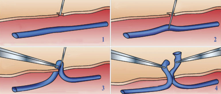 Операция минифлебэктомия при варикозе нижних конечностей